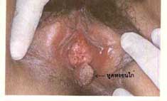 หูดหงอนไก่-หญิง