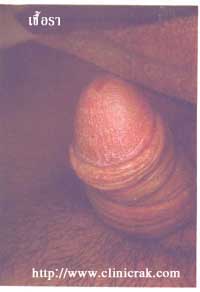 candidiasis