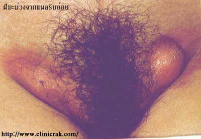 chancroid