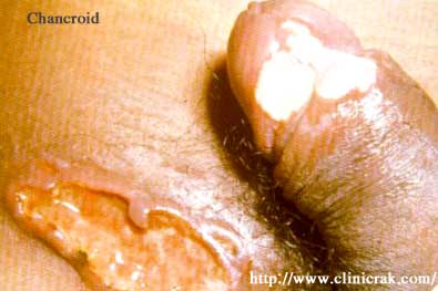 chancroid