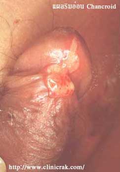 chancroid