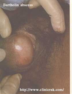 gonococcal urethritis complication