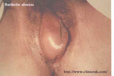 gonococcal urethritis complication