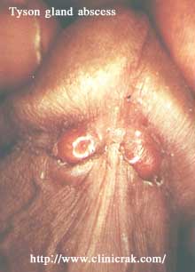 gonococcal urethritis 