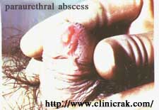 gonococcal urethritis 