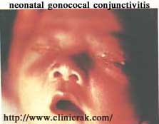gonococcal urethritis 