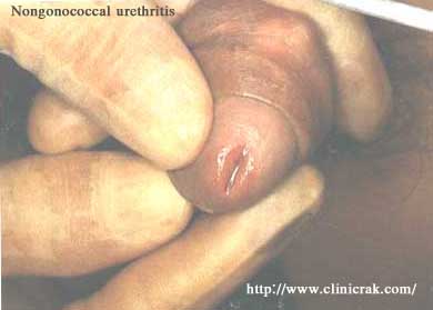 nongonococcal urethritis 