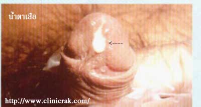 gonococcal urethritis 