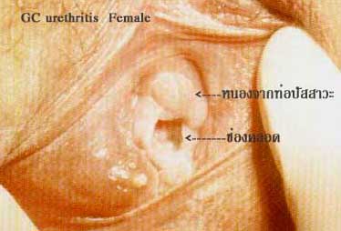gonococcal urethritis 