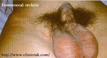 gonococcal urethritis 