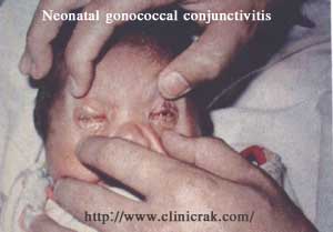 neonatal gonococcal conjunctivitis