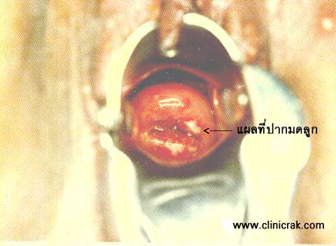 herpes simplex female