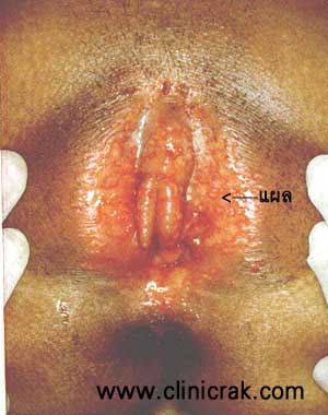 herpes simplex female