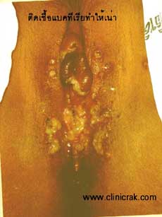 herpes simplex female