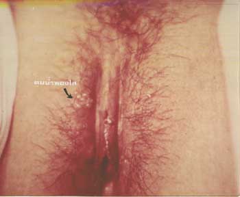 herpes simplex female