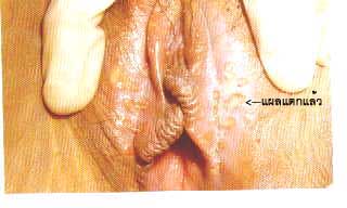 herpes simplex female