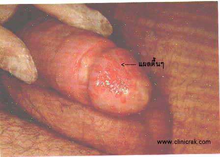 herpes simplex male
