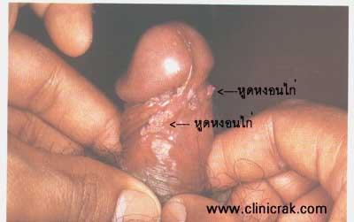 Codyloma accumunata, HPV