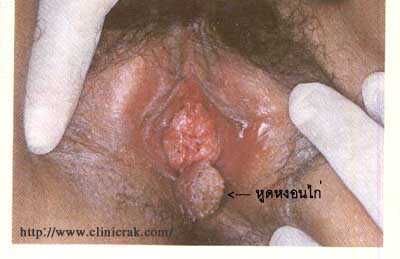 Codyloma accumunata  HPV