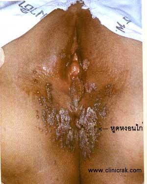 Codyloma accumunata  HPV
