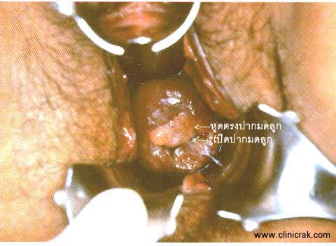 Codyloma accumunata, HPV