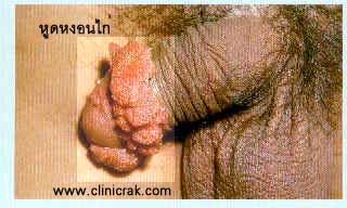 Codyloma accumunata, HPV