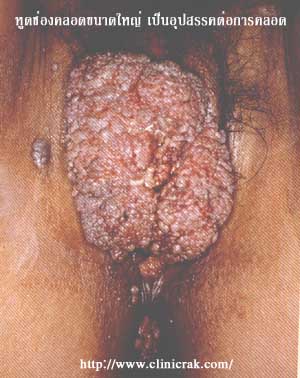 Codyloma accumunata, HPV