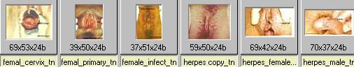 herpes genitalis