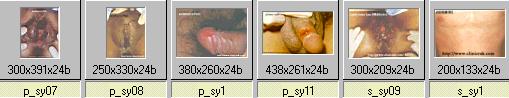 syphilis