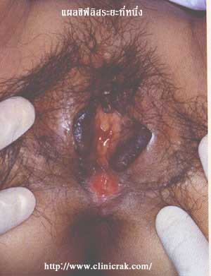 Syphilis