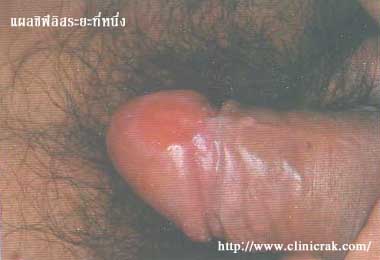 Syphilis