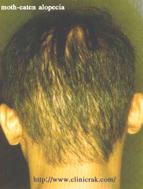 Syphilis