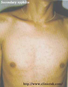 Syphilis