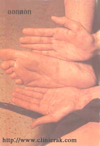 Syphilis