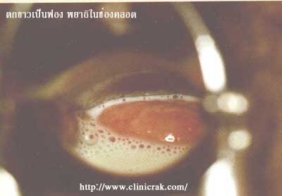 vagina trichomoniasis